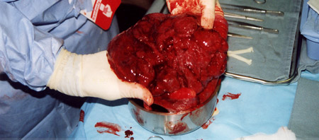 What does a placenta look like? - FindersFree: What do you ...