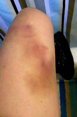What causes a bruise? - FindersFree: What do you want to find out?