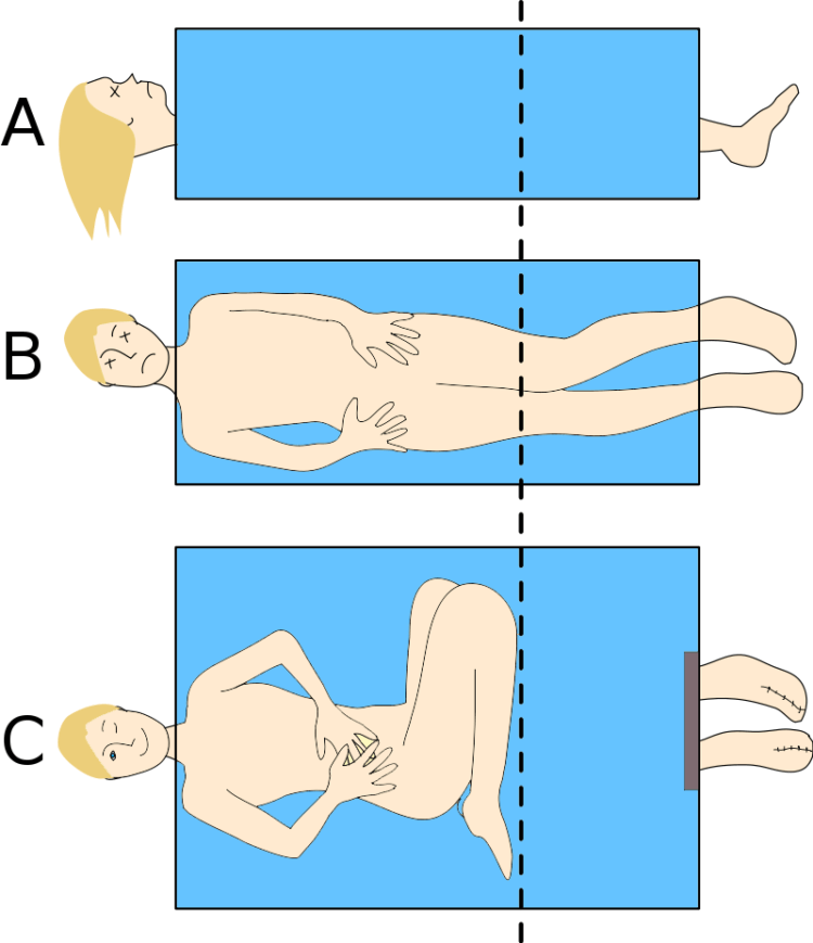  Sciage d'une personne en demi-illusion 