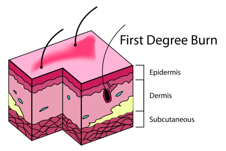 First-degree burns - diagram