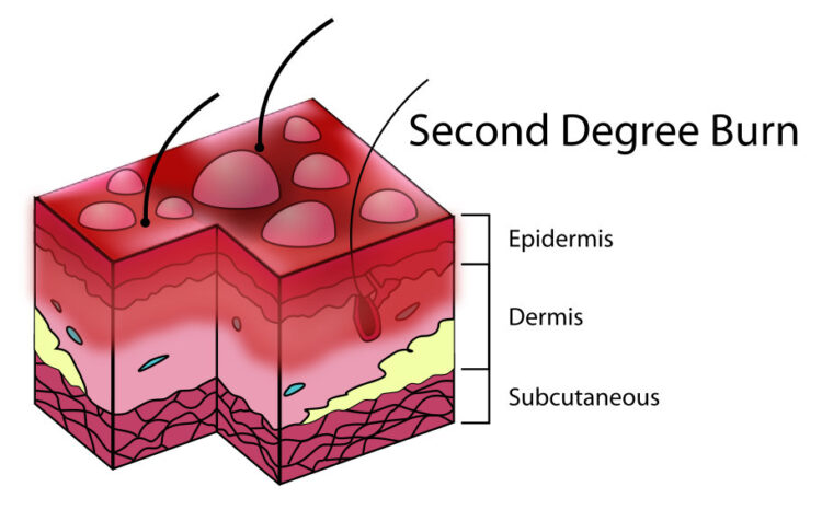 Second-degree burns - diagram