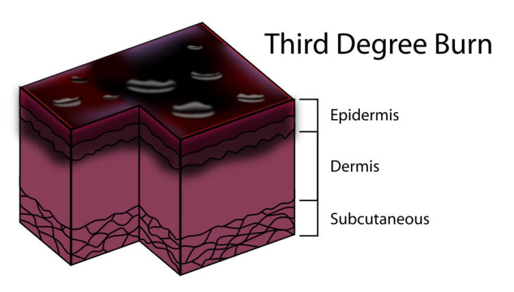 Third-degree burns - diagram